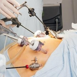 Global Bariatric Surgery Market Forecast Report Up to 2031