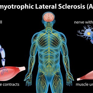 Amyotrophic Lateral Sclerosis Market Forecast Up to 2030