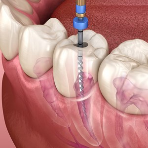 Root Canal Irrigatos Market Size, Global Key Players, Types, Applications, Countries & Forecast 2022 to 2030