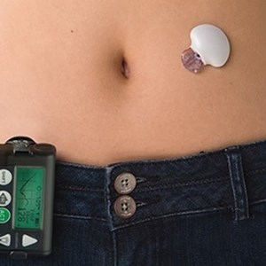 Artificial Pancreas Device System Market Future Innovations, Growth Elements, and Recent Development by 2030