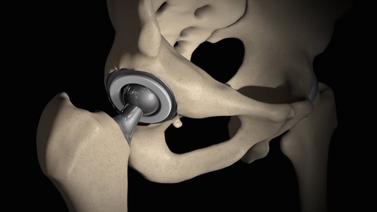 Hip Articular Prostheses Market Scope, Demand, Growth, Regional Analysis 2022 to 2030