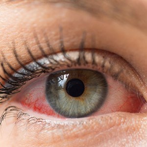 Dry Eye Drugs Market Analysis, Business Development, Size, Share, Trends, Future Growth, Forecast to 2030