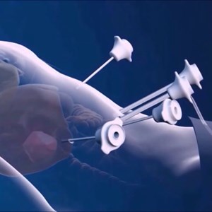  Minimally Invasive Neurosurgical Device Market Global Key Players, Types, Applications, Countries & Forecast 2022 to 2030