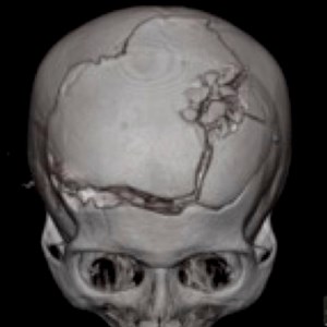 Bullet, Nail & Bolt: Penetrating Brain Injuries in Austria