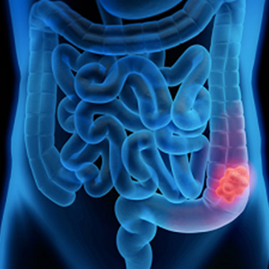 Colorectal Cancer: Understanding the Symptoms, Diagnosis, and Treatment Options