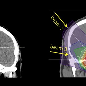 Proton Therapy for CNS and Skull Base Tumors is Gentle on Surrounding Brain Tissue
