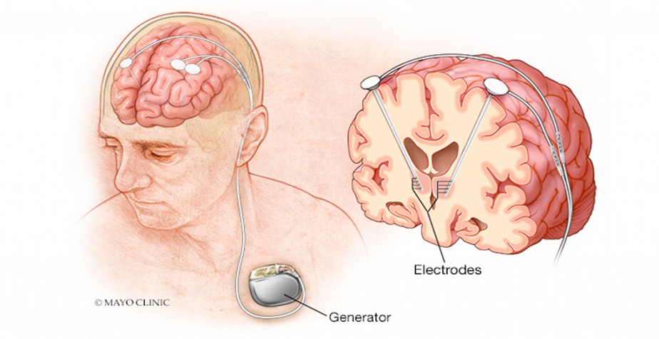 Global Deep Brain Stimulators Market is Expected to Grow at a CAGR of over 8.5% During 2024-2034