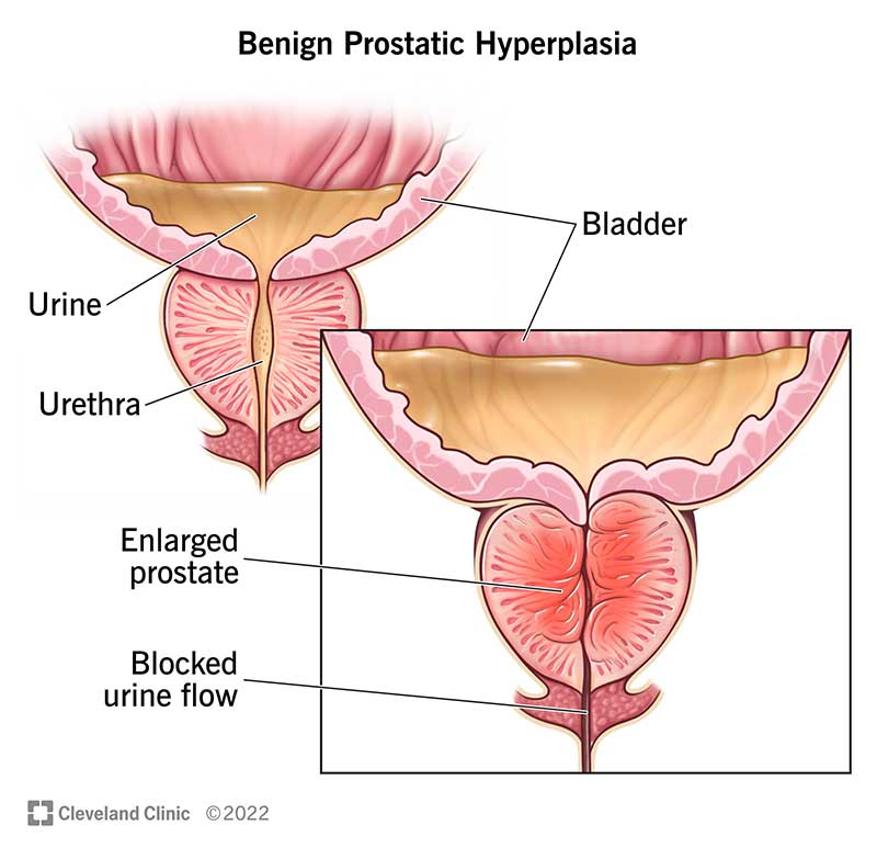 Benign Prostatic Hyperplasia Treatment Market Report 2025-2035 with Profiles of Leading Players - Abbott Laboratories, AbbVie, Astellas Pharma Inc, Eli Lilly and Company, Merck & Co