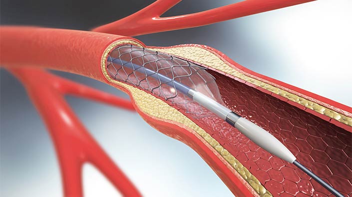 Interventional Cardiology Devices Market Size, Share, Growth and Demand by Region and Forecast to 2031