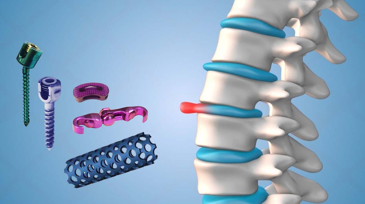 Spinal Implants Market: Growth Outlook, Emerging Innovations, and Strategic Industry Insights