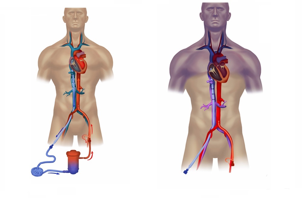 Extracorporeal Membrane Oxygenation (ECMO) Market Get Facts About Business Strategies 2024 to 2029:Medi-tech Insights