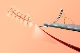 Surgical Sutures Market: Growth Drivers, Trends, Challenges, and Regional Insights