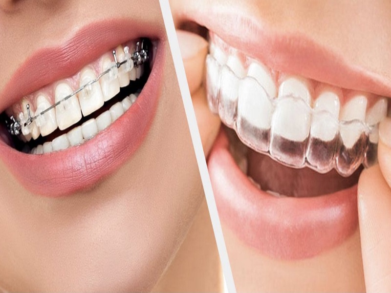 Orthodontics Market 2026 | Size, Share, Trends, and Growth by Forecast, 2035