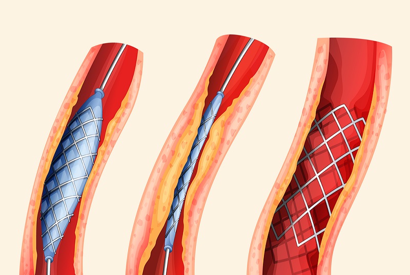 4D Printing in Healthcare Market: Growth, Opportunities, Key Players & Forecast Outlook 2035