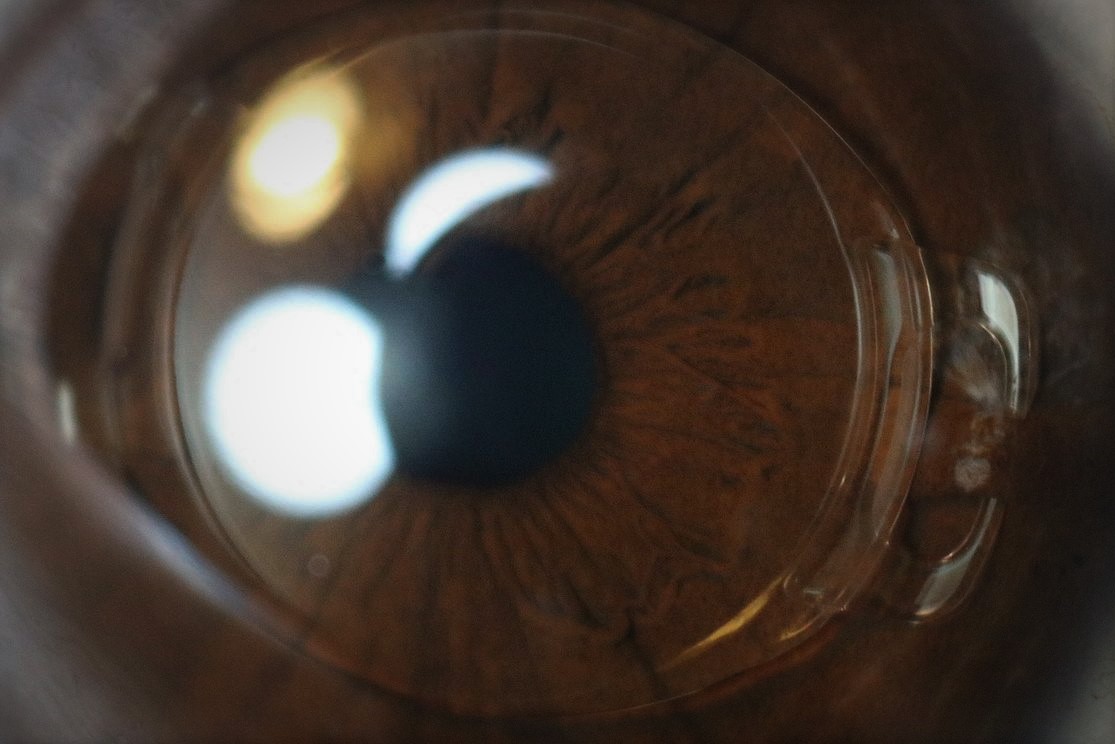 Intraocular Lens Market: Sharpening Vision Through Innovation and Precision