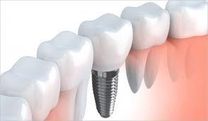 Dental Biomaterials Market 2026 | Research Report, Size, Share, Analysis, Growth by Region and Forecast, 2030