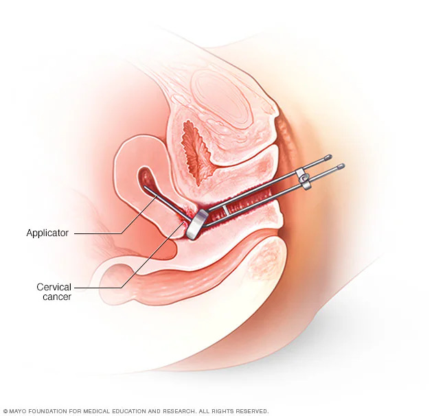 Brachytherapy Market | In-Depth Examination of Segments, Industry Trends, and Key Competitors and Forecast to 2030