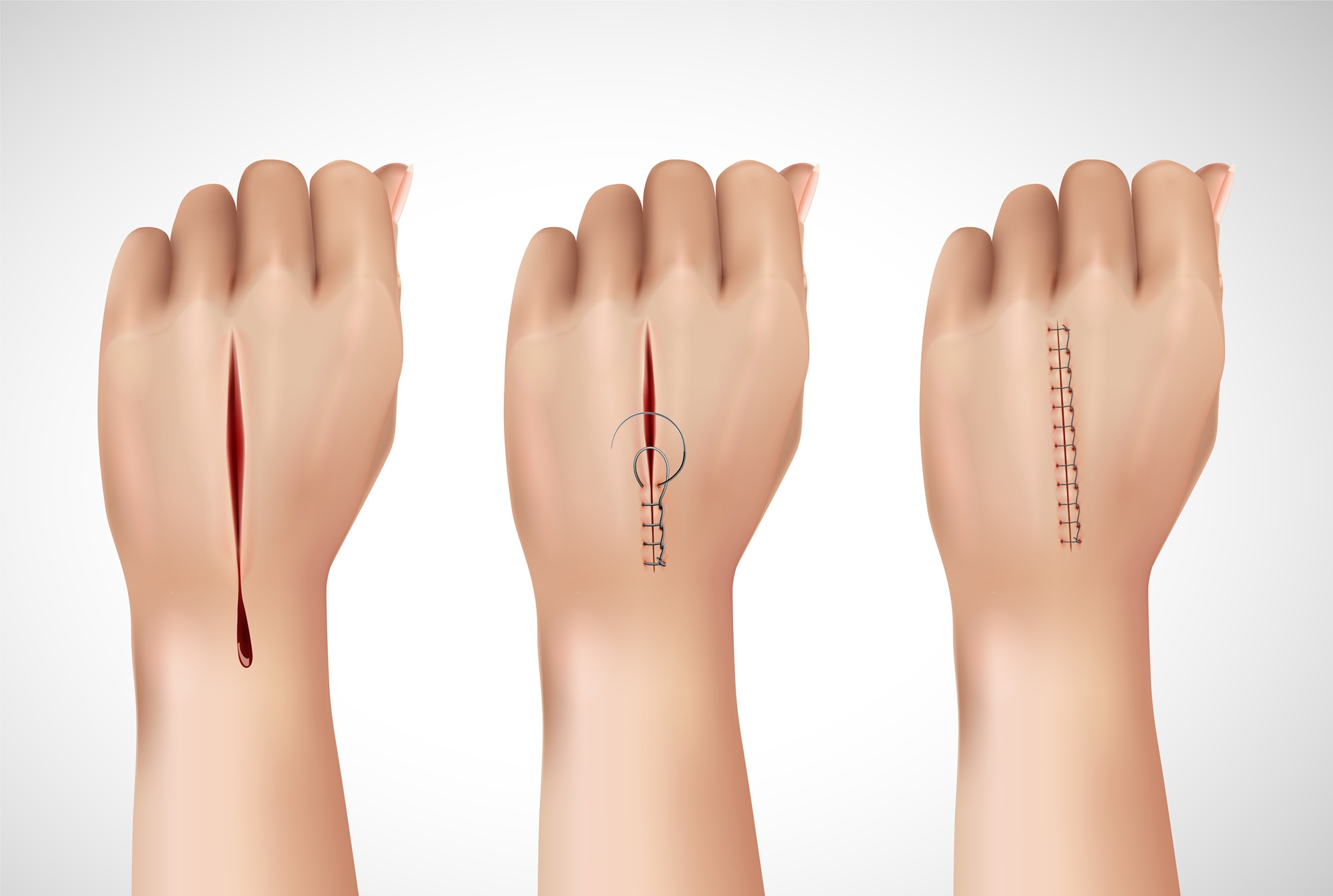 Advanced Wound Closure Market Growth - Market Analysis, Size, Share, Trends, Demand, Overview and Segment Forecast To 2031