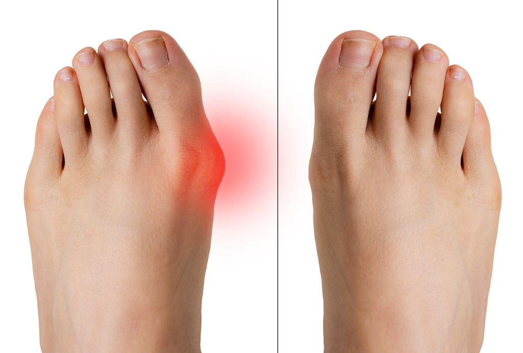 Bunion Surgery Market: Growth Outlook, Segmentation & Industry Trends (2026-2031)