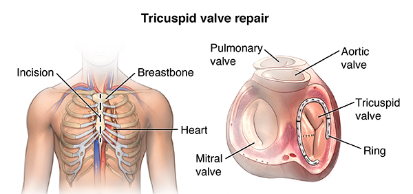 Tricuspid Valve Repair Market Will Generate Booming Growth Opportunities to 2031