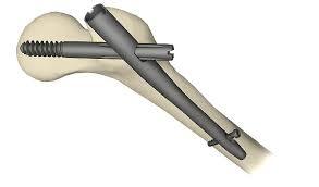 Nailing Systems Market: Forecasted Demand and Leading Key Players Analysis Through 2031