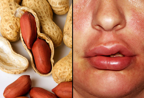 Peanut Allergy Treatment Market Set for Significant Growth by 2031, Driven by Emerging Targeted Therapies and Rising Disease Awareness