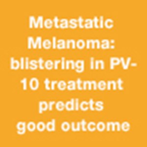 Metastatic Melanoma: blistering in PV-10 treatment predicts good outcome
