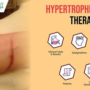 Hypertrophic Scars Therapeutics Pipeline Analysis, Clinical Trials and Developments